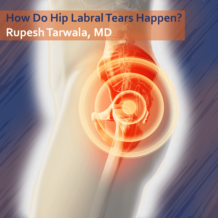 Hip Labral RT