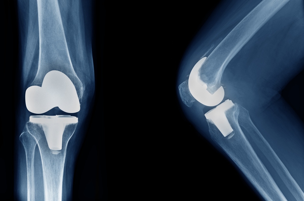 Revision Total Knee Replacement